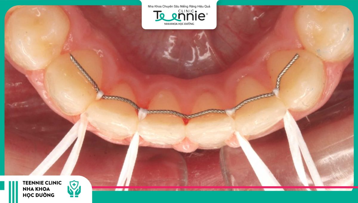 Hàm duy trì cố định không thể tự tháo lắp