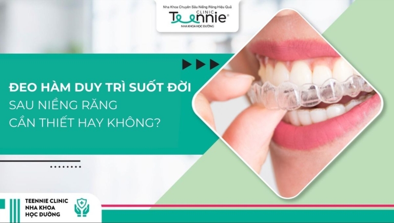 Niềng răng có cần đeo hàm duy trì suốt đời hay không?