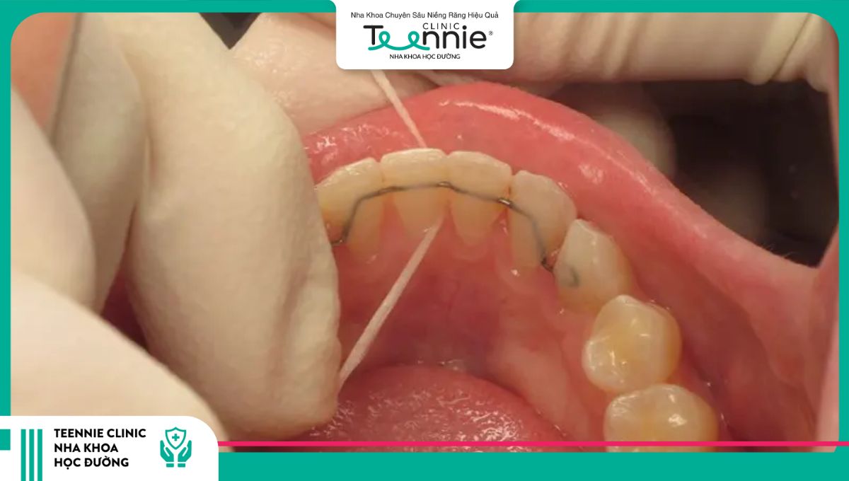 Vệ sinh toàn hàm duy trì cố định cần thêm dụng cụ hỗ trợ