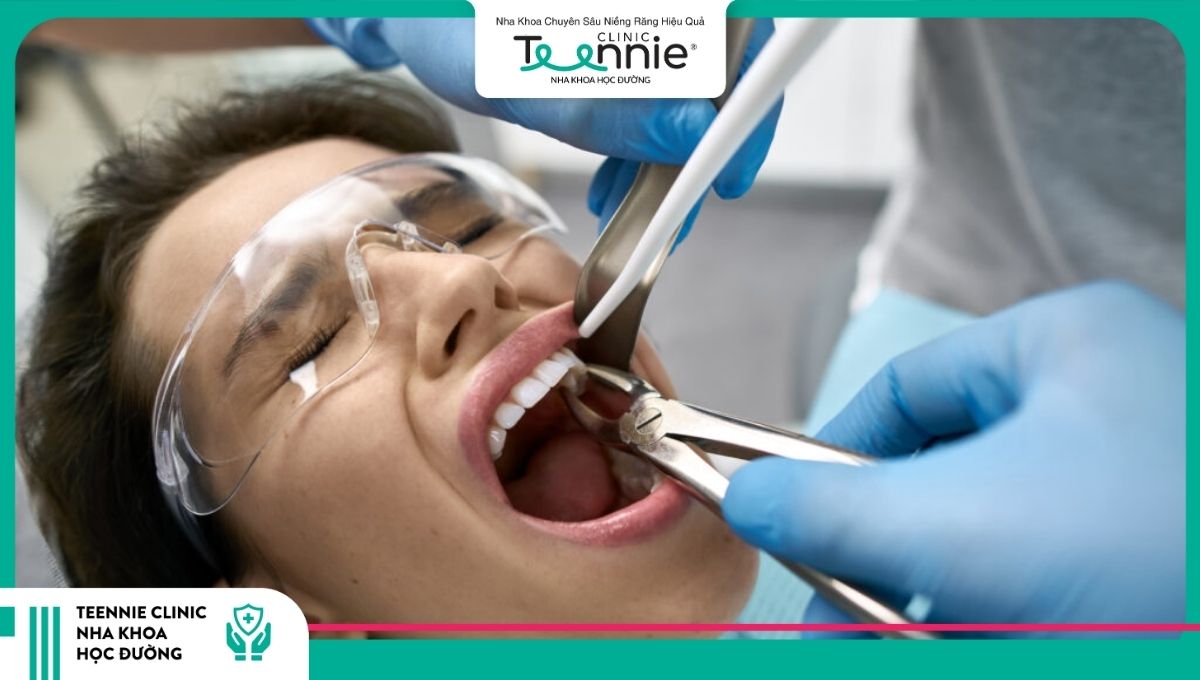Một số trường hợp cần nhổ răng trước khi niềng