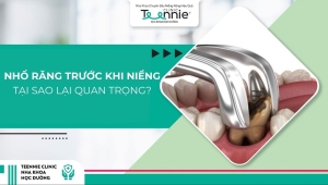 Tại sao nhổ răng trước khi niềng lại quan trọng?