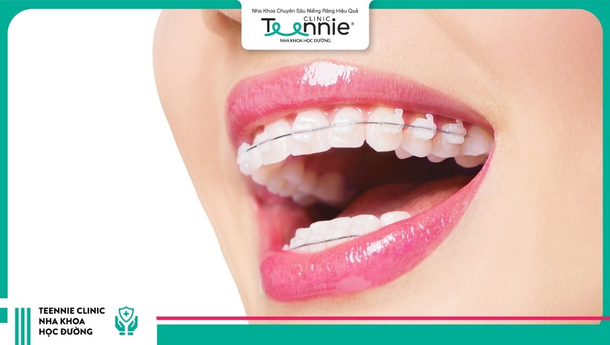 Không phải ai cũng cần nhổ răng trước khi niềng