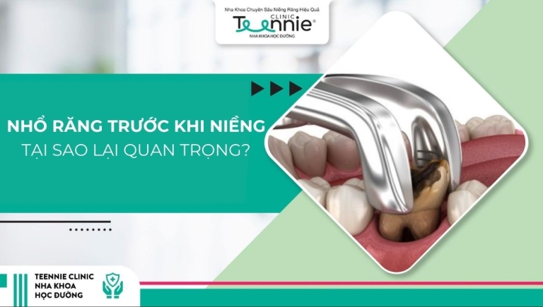 Tại sao nhổ răng trước khi niềng lại quan trọng?