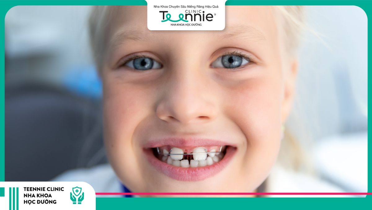 Niềng răng có bị rụng răng không là câu hỏi phổ biến của nhiều người khi niềng