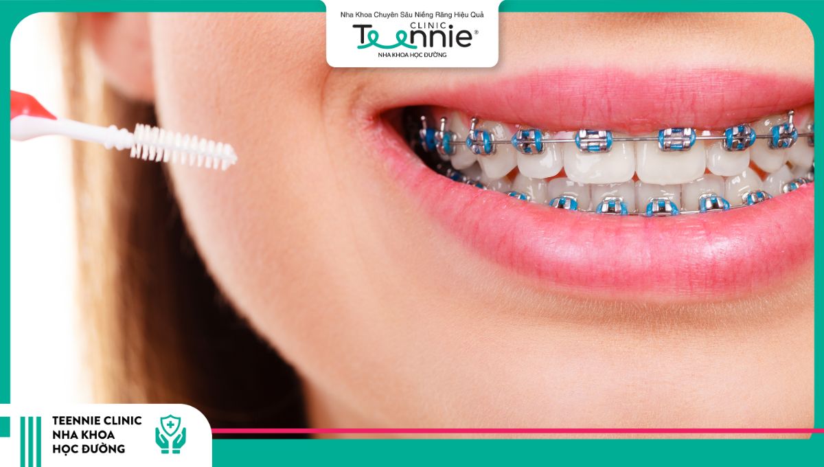 Vệ sinh răng miệng kém khiến răng có nguy cơ bị rụng sớm