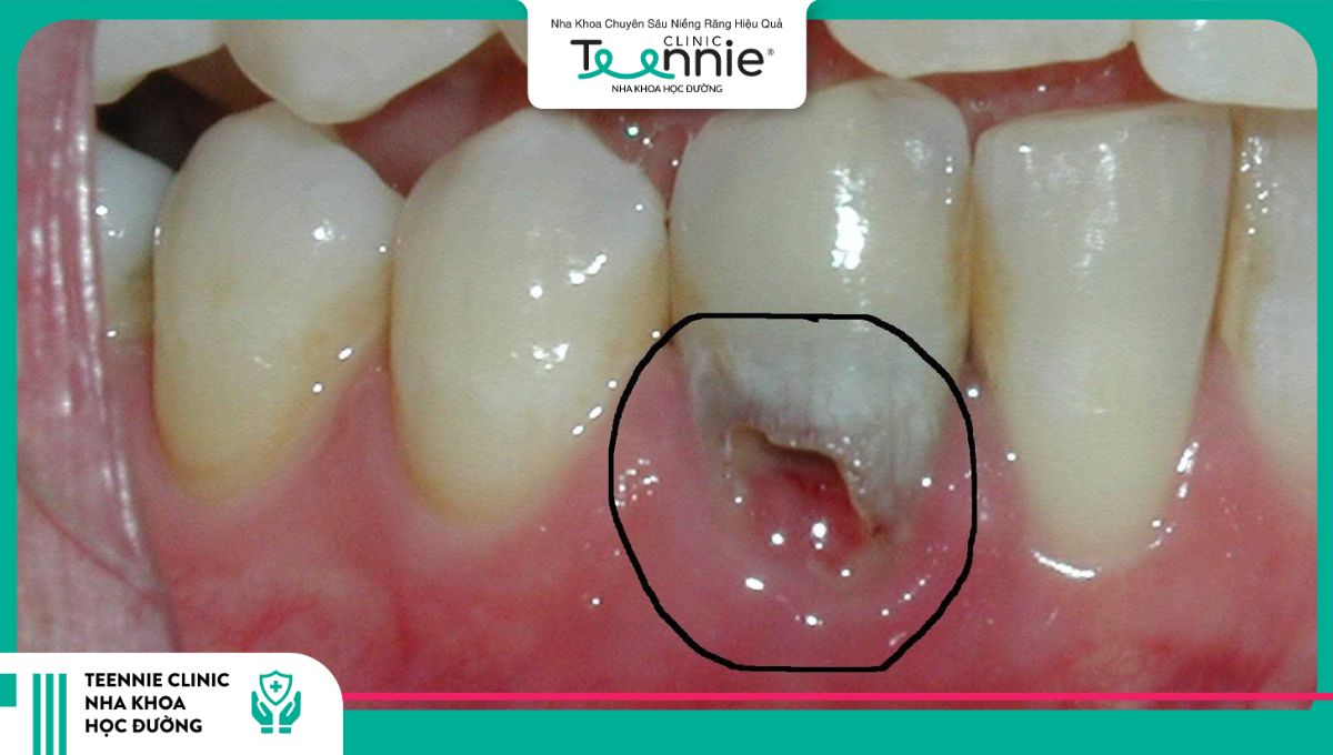 Hiện tượng tiêu chân răng gặp phải khi niềng răng