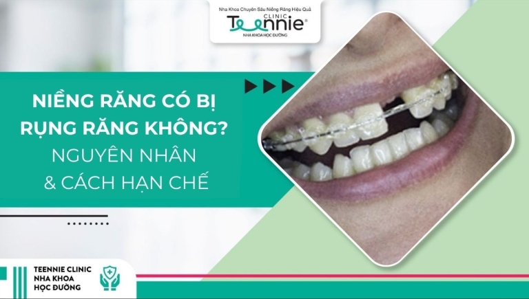 Niềng răng có bị rụng răng không? Nguyên nhân và cách hạn chế