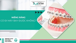 Niềng răng có đi máy bay được không? Và cần lưu ý điều gì?