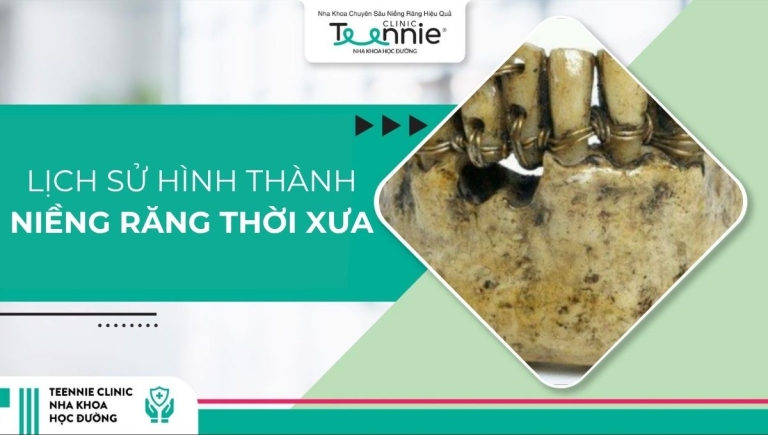 Tìm hiểu về lịch sử hình thành niềng răng thời xưa