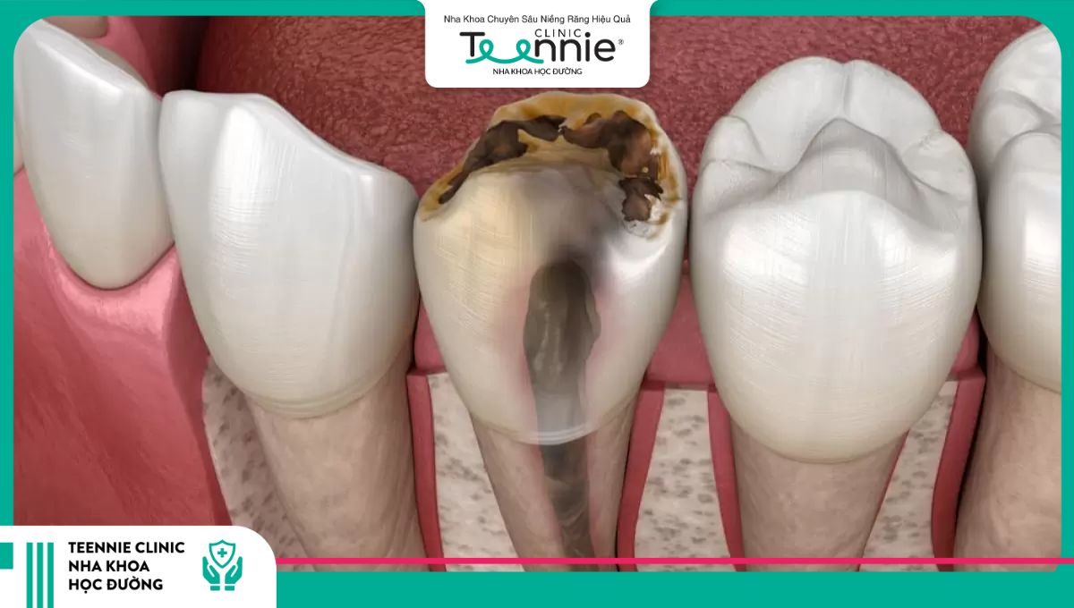Răng sâu nặng tới tủy cần điều trị phức tạp hơn trước khi niềng