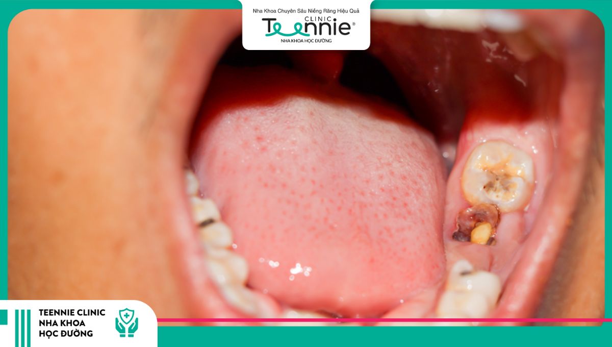 Răng sâu vỡ hết thân răng cần phải nhổ răng trước khi niềng