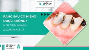 Răng sâu có niềng được không? Nguyên nhân và hướng xử lý