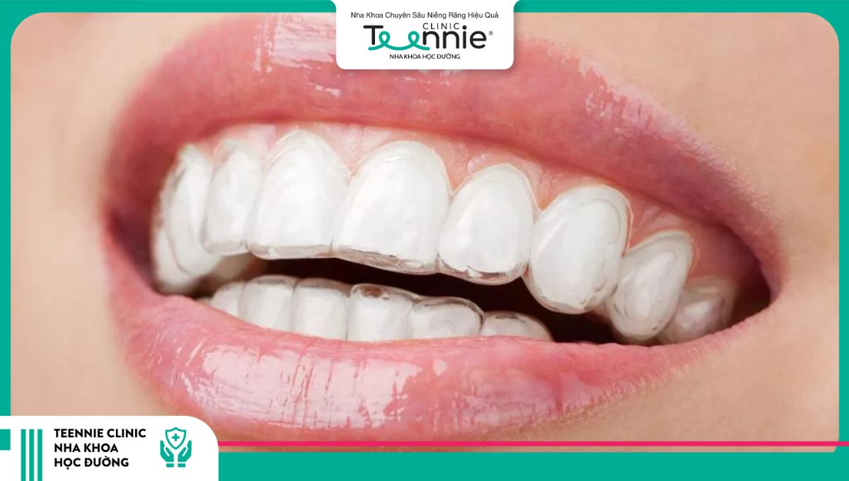 Niềng răng trong suốt Invisalign hạn chế tình trạng sâu răng khi đang niềng