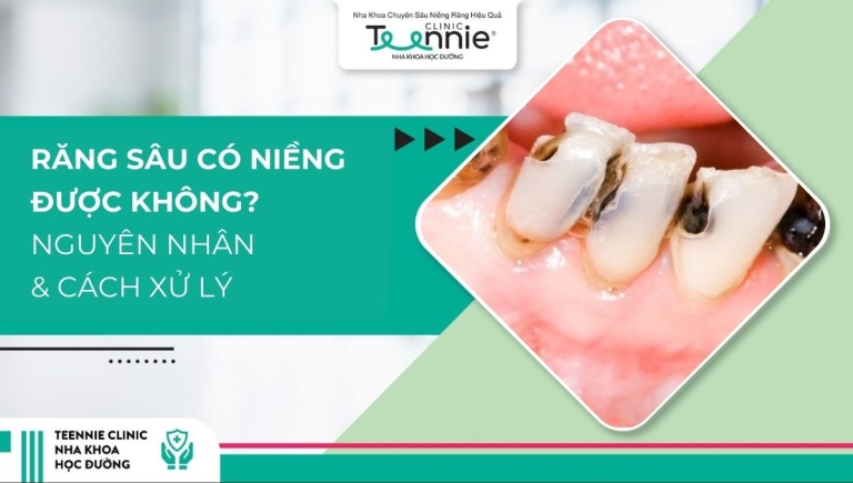 Răng sâu có niềng được không? Nguyên nhân và hướng xử lý