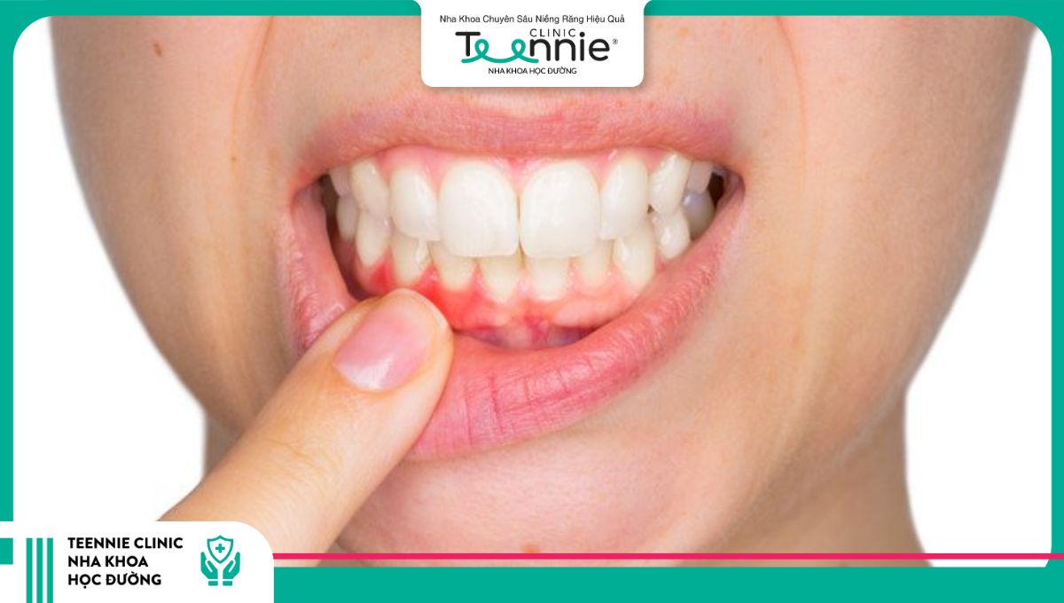 Vệ sinh răng miệng không đúng cách gây ra tình trạng tam giác đen ở răng