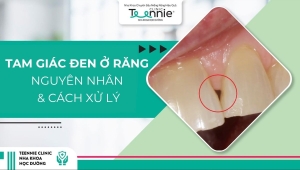 Nguyên nhân và cách xử lý tam giác đen ở răng hiệu quả