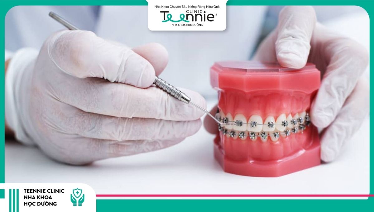 Đã từng trồng răng có niềng được không?