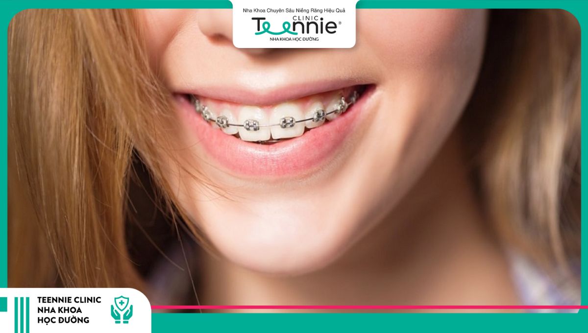 Bạn nên ưu tiên niềng răng trước khi thực hiện trồng răng
