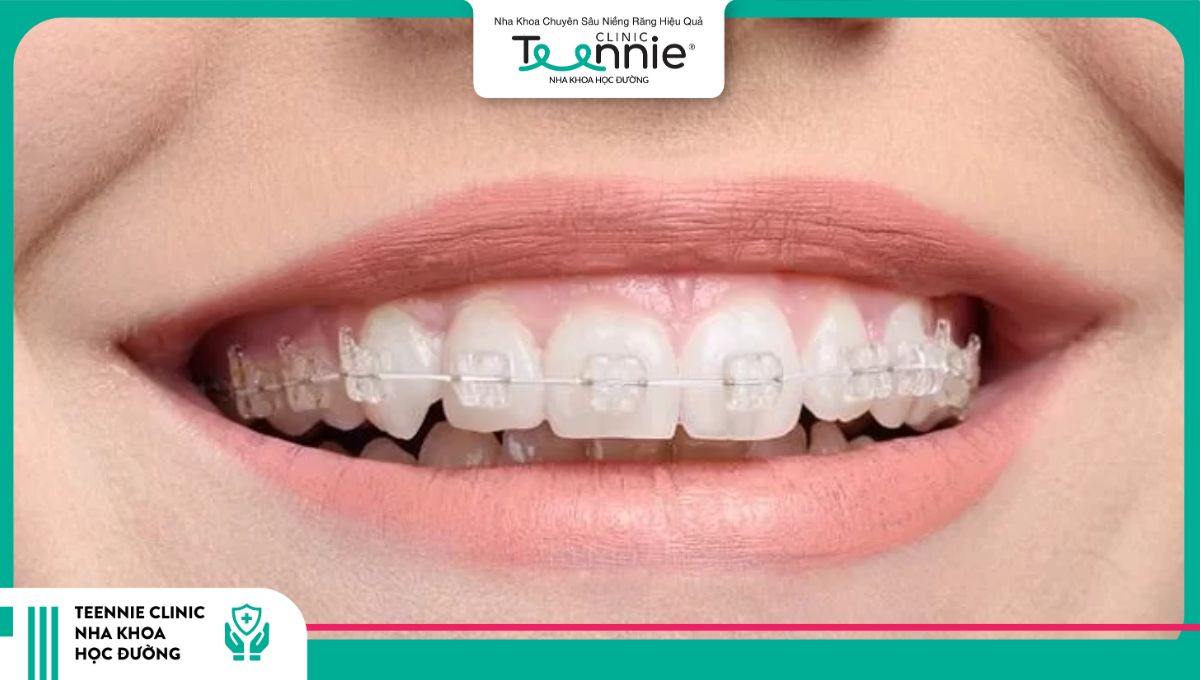 Niềng răng mắc cài sứ
