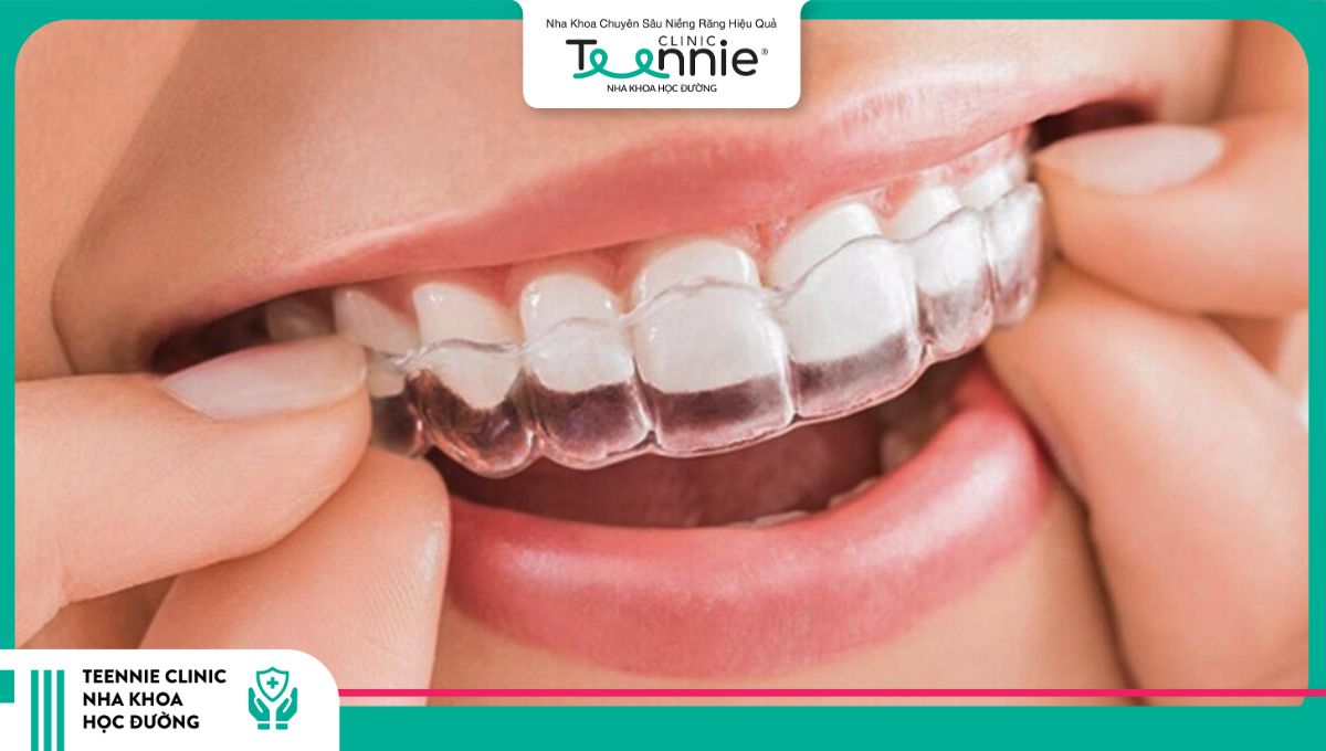 Niềng răng trong suốt Invisalign
