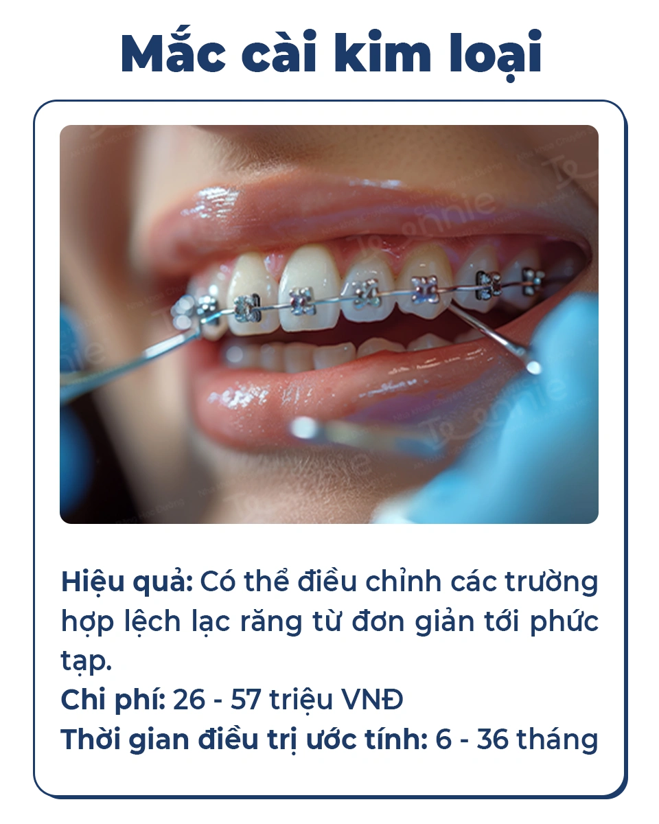 Mắc cài kim loại