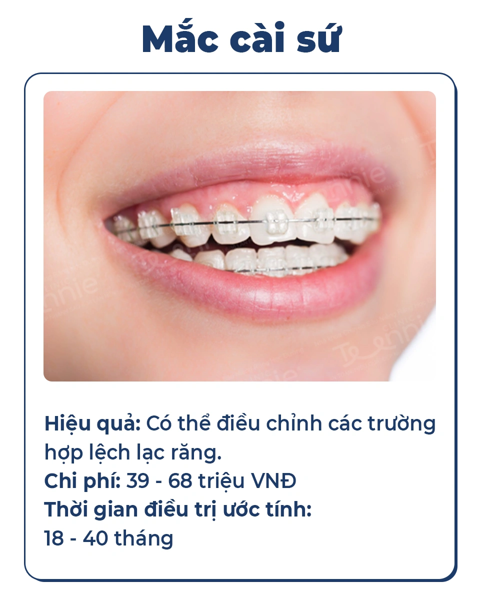 Mắc cài sứ
