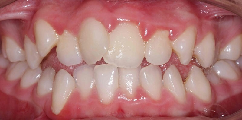 bang gia nieng rang 2026 tai teennie cap nhat moi nhat theo tung phuong phap 2