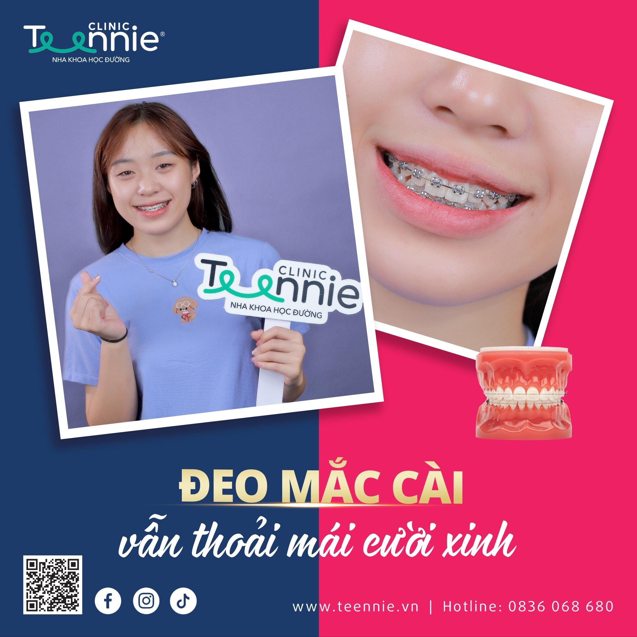 mắc cài kinh điển - hình 5