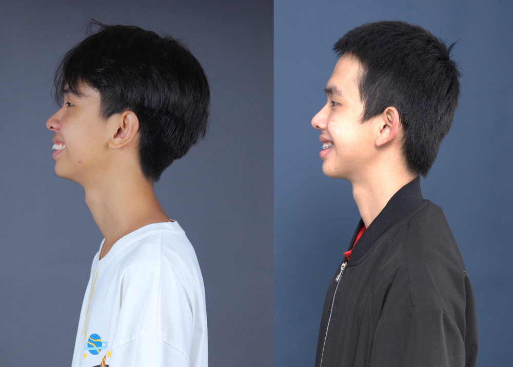 niềng răng hô - hình 3