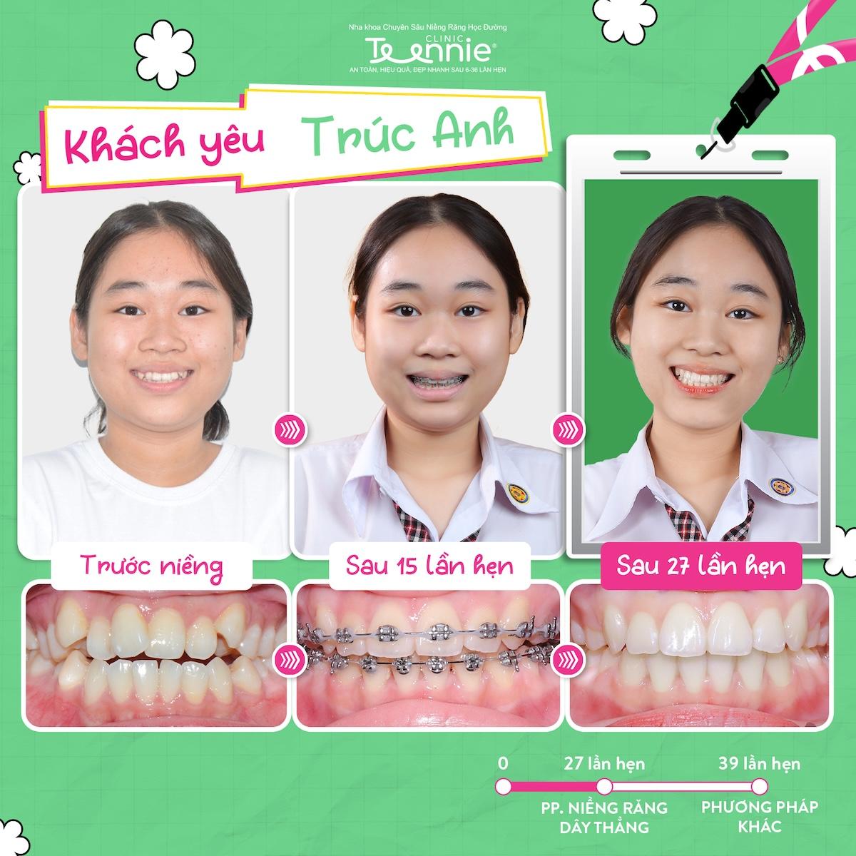 niềng răng học sinh - hình 2