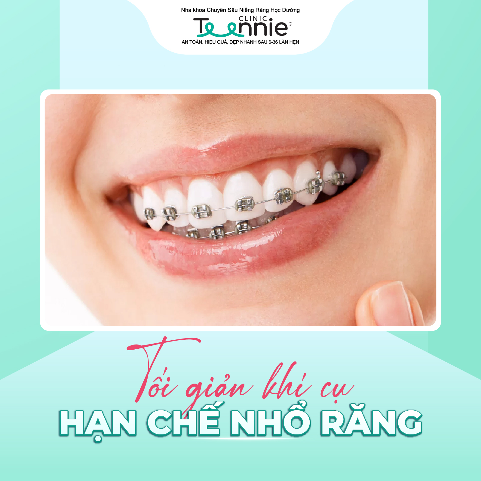 niềng răng kim loại