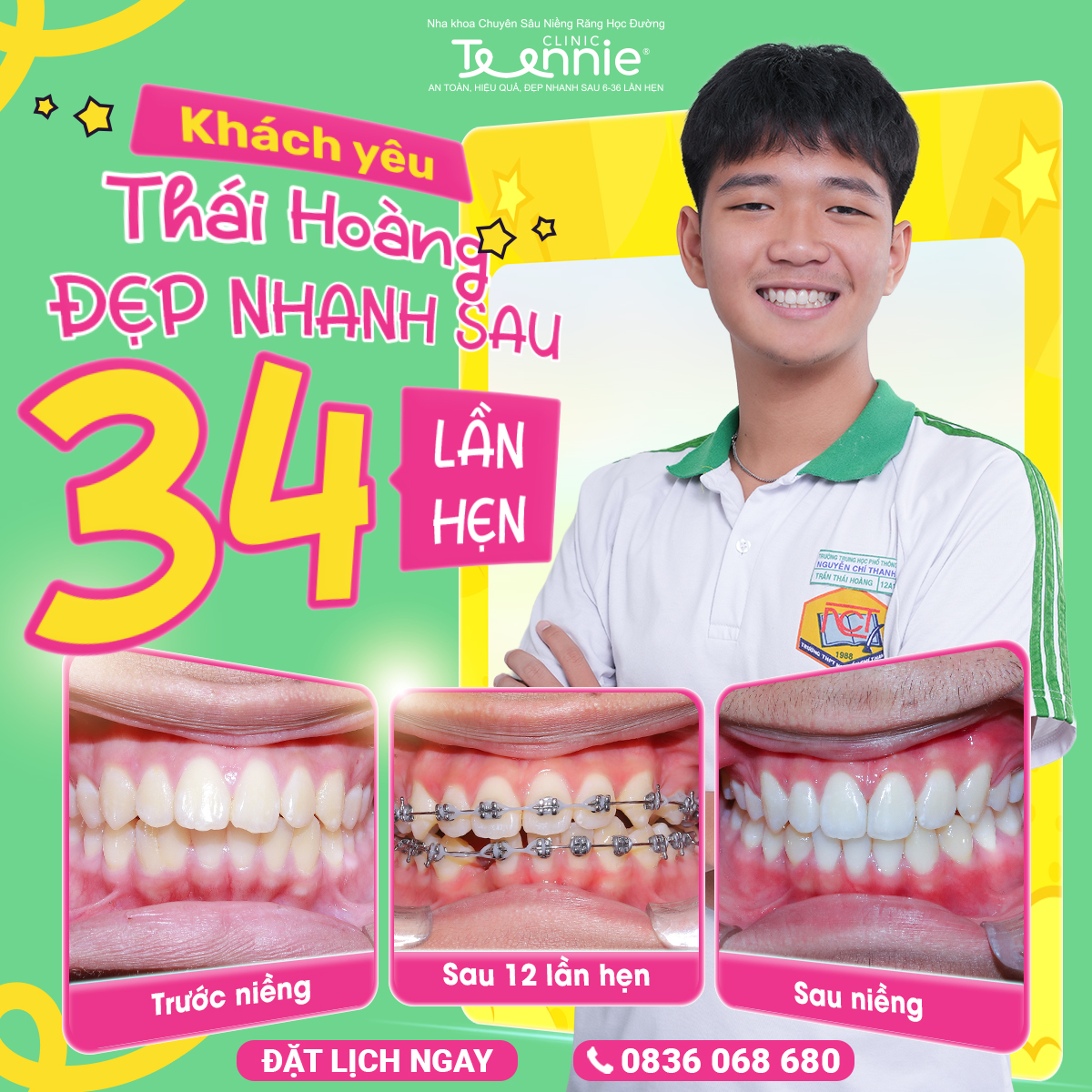 niềng răng kim loại - hình 2