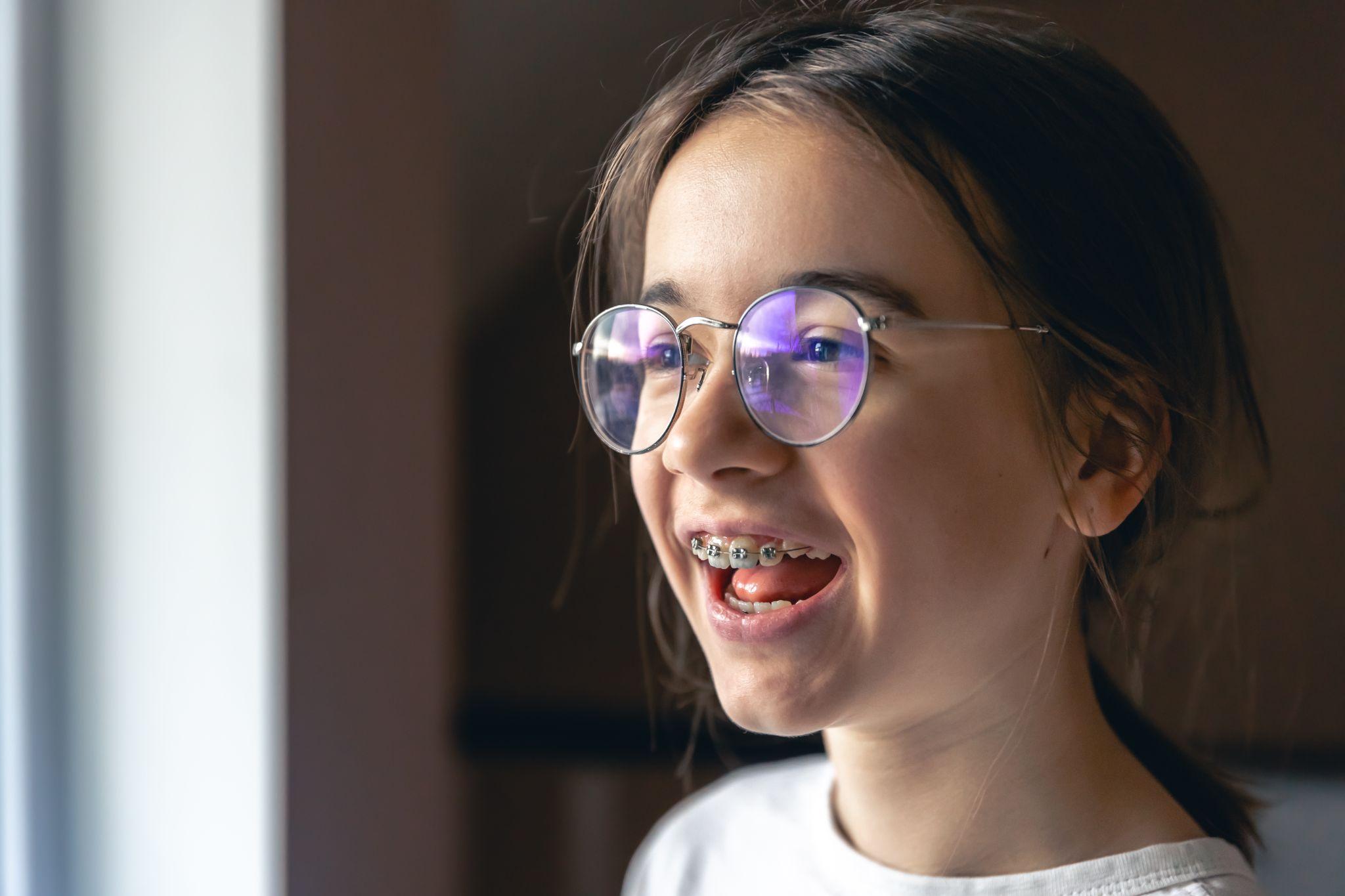 niềng răng móm - hình 4