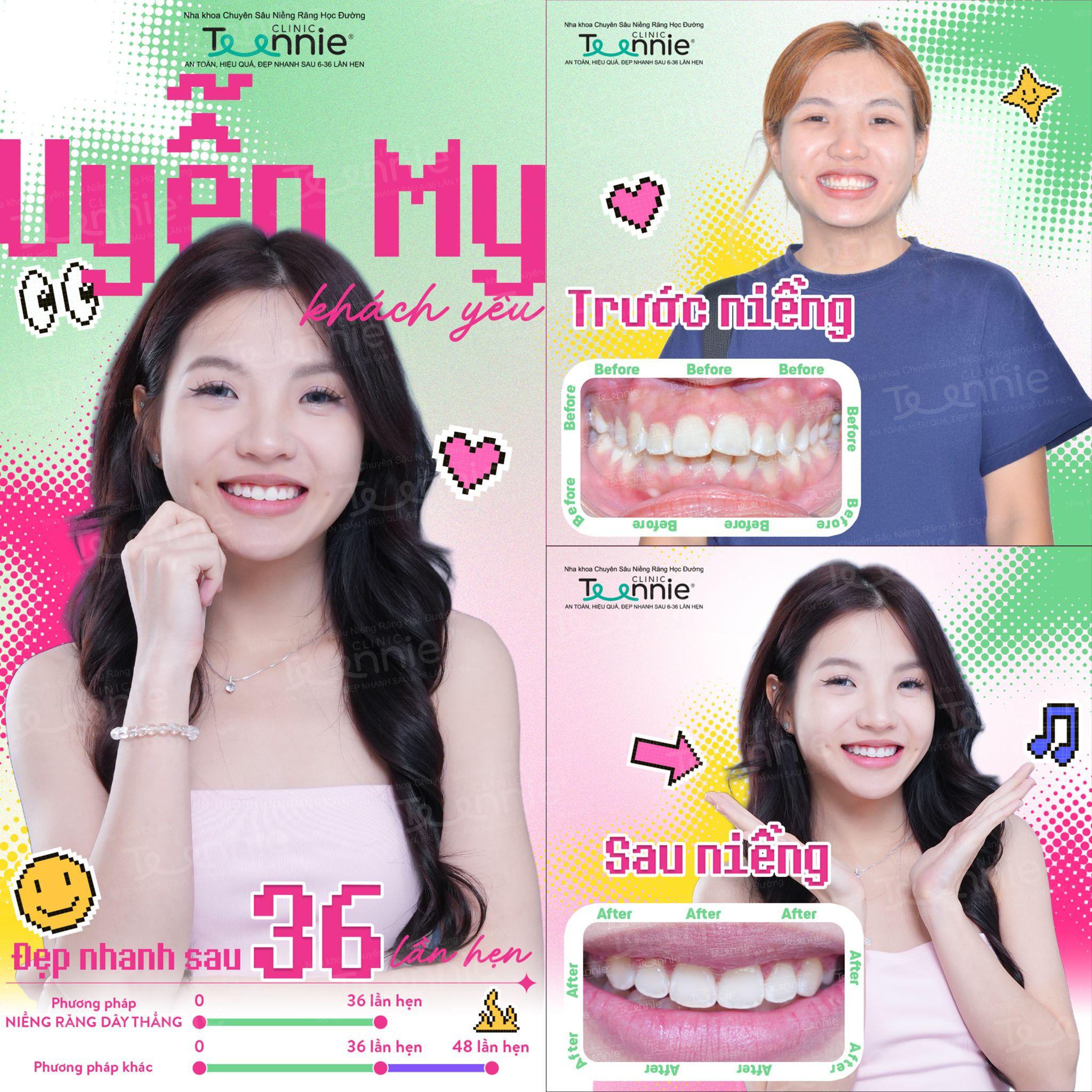 niềng răng tphcm - hình 4