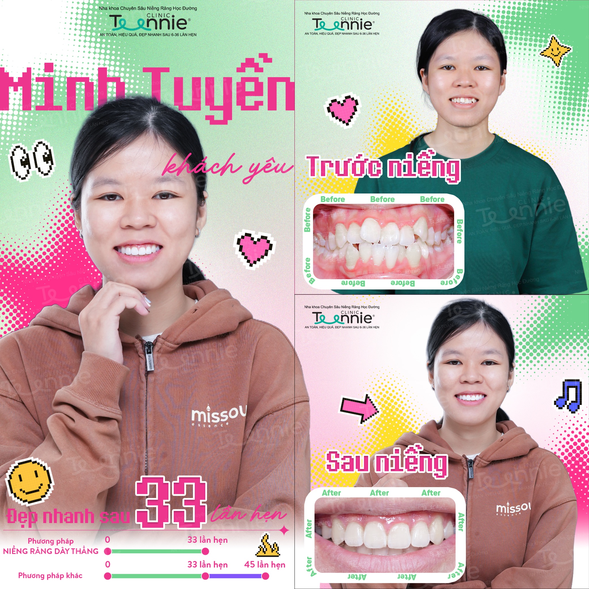 niềng răng khấp khểnh - hình 7