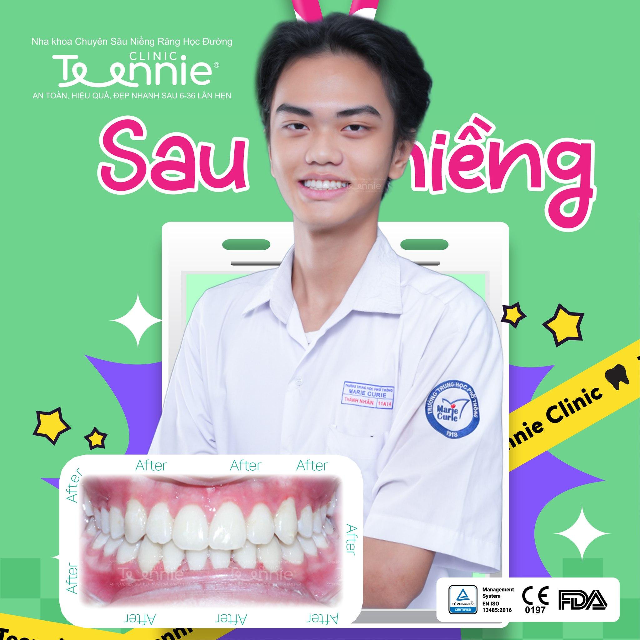 niềng răng sinh viên tphcm - hình 4