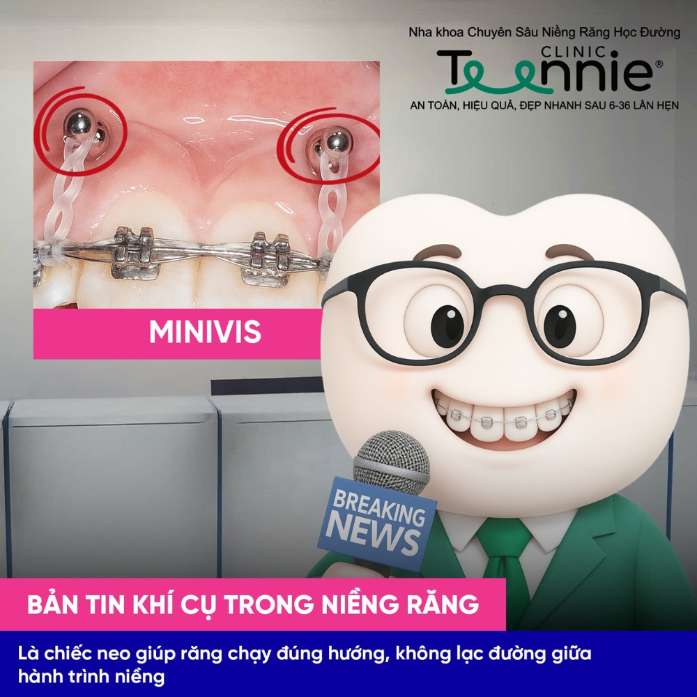 cam minivis nieng rang 1
