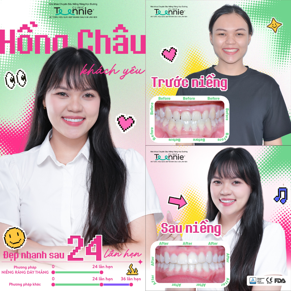 hàm duy trì sau niềng - hình 2