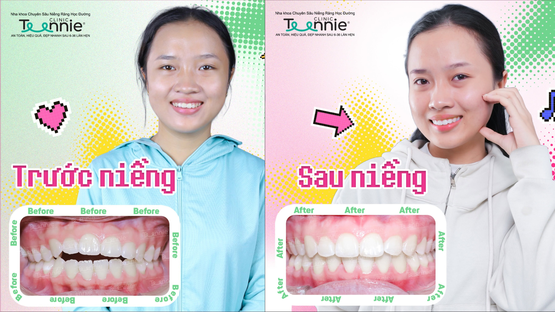 niềng răng cắn hở - hình 3