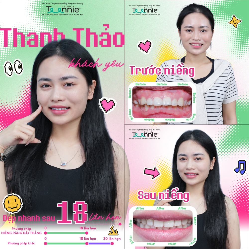 niềng răng cắn sâu