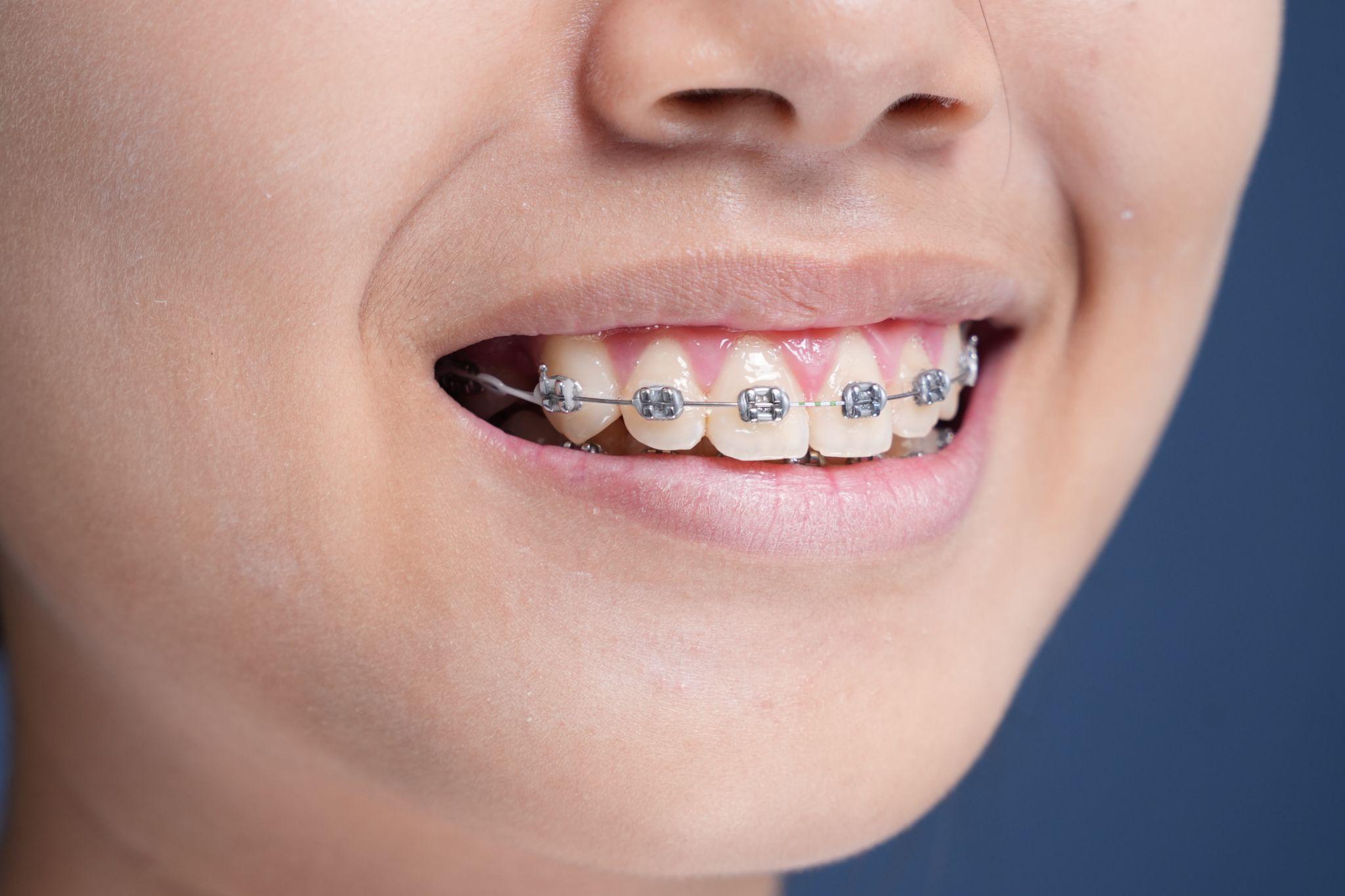 niềng răng cắn sâu - hình 2
