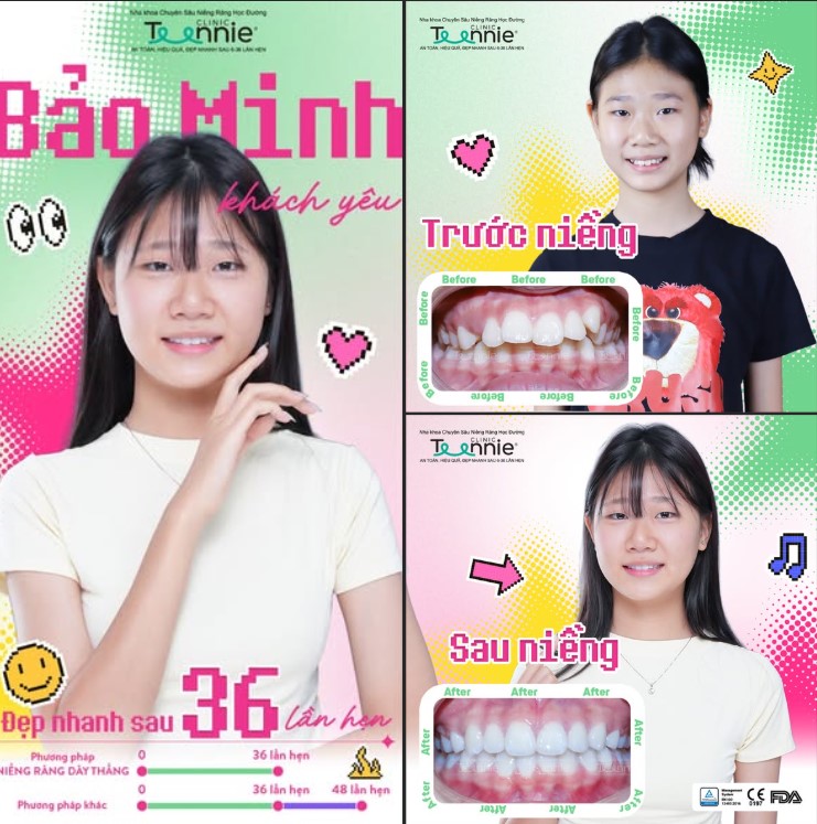 niềng răng cắn sâu - hình 3