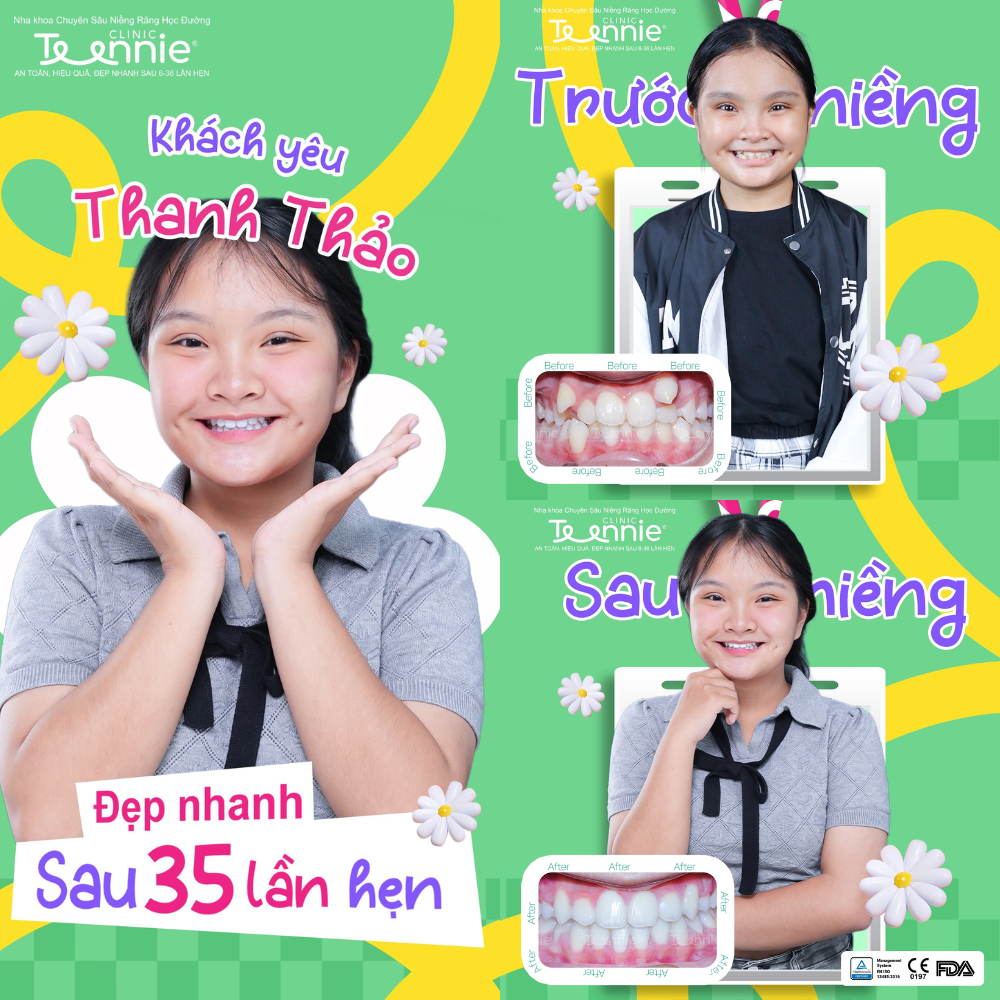 niềng răng cắn sâu - hình 4