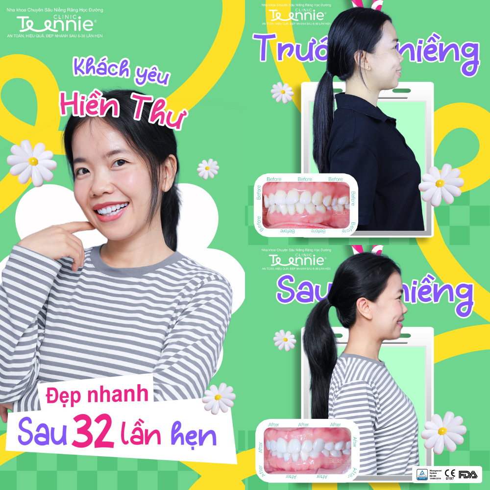 niềng răng cười hở lợi - hình 2