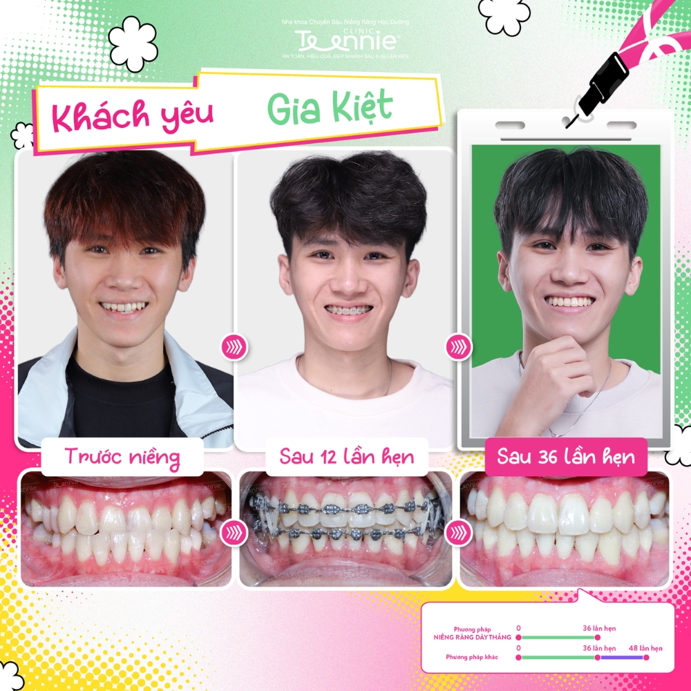 niềng răng học sinh - hình 5