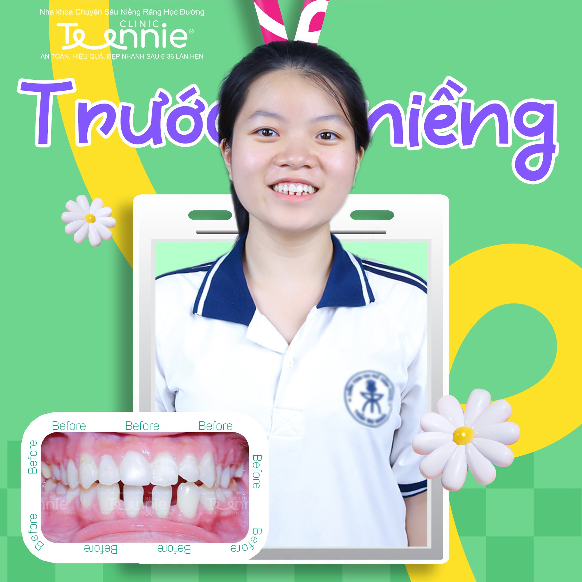 niềng răng thưa - hình 2