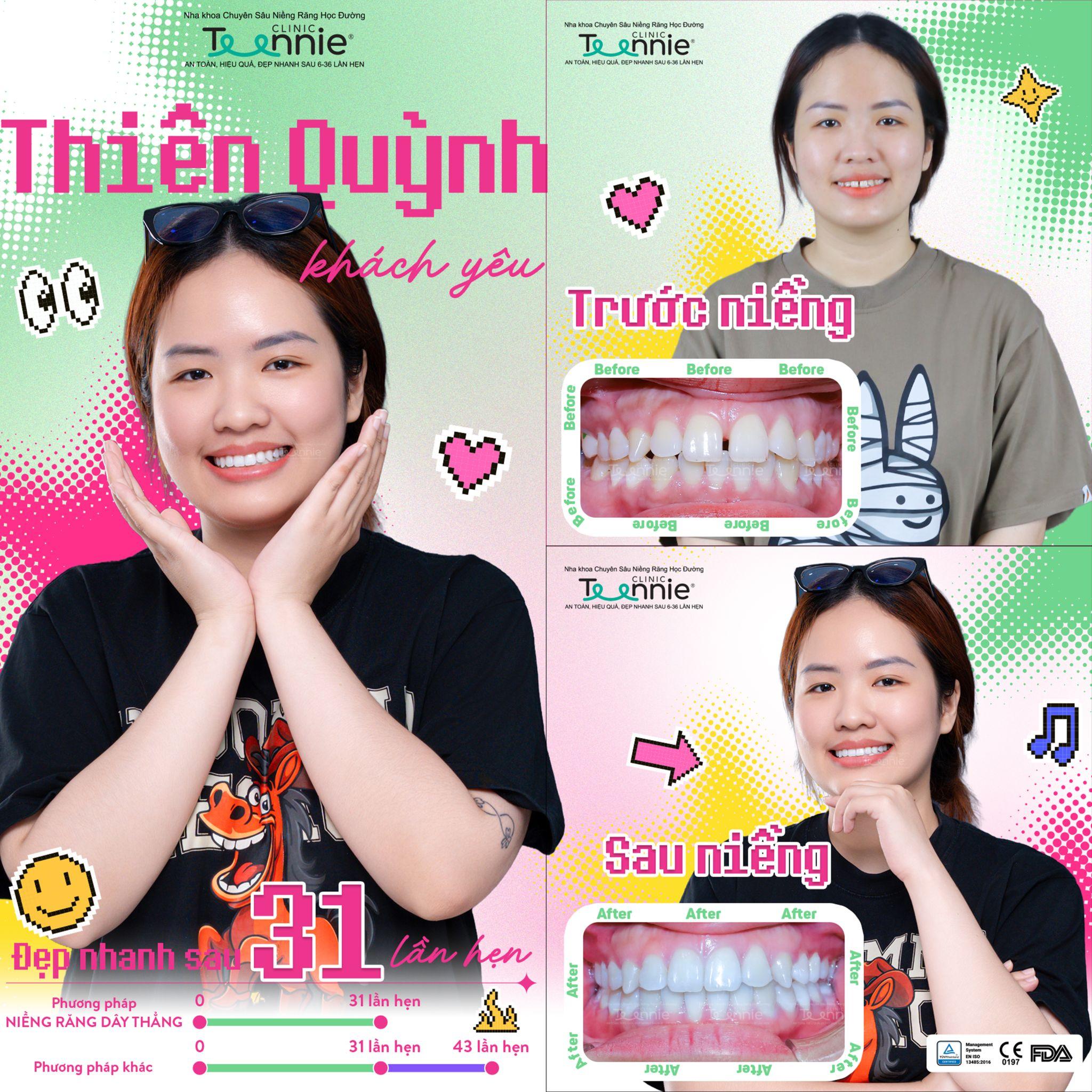 niềng răng thưa - hình 4
