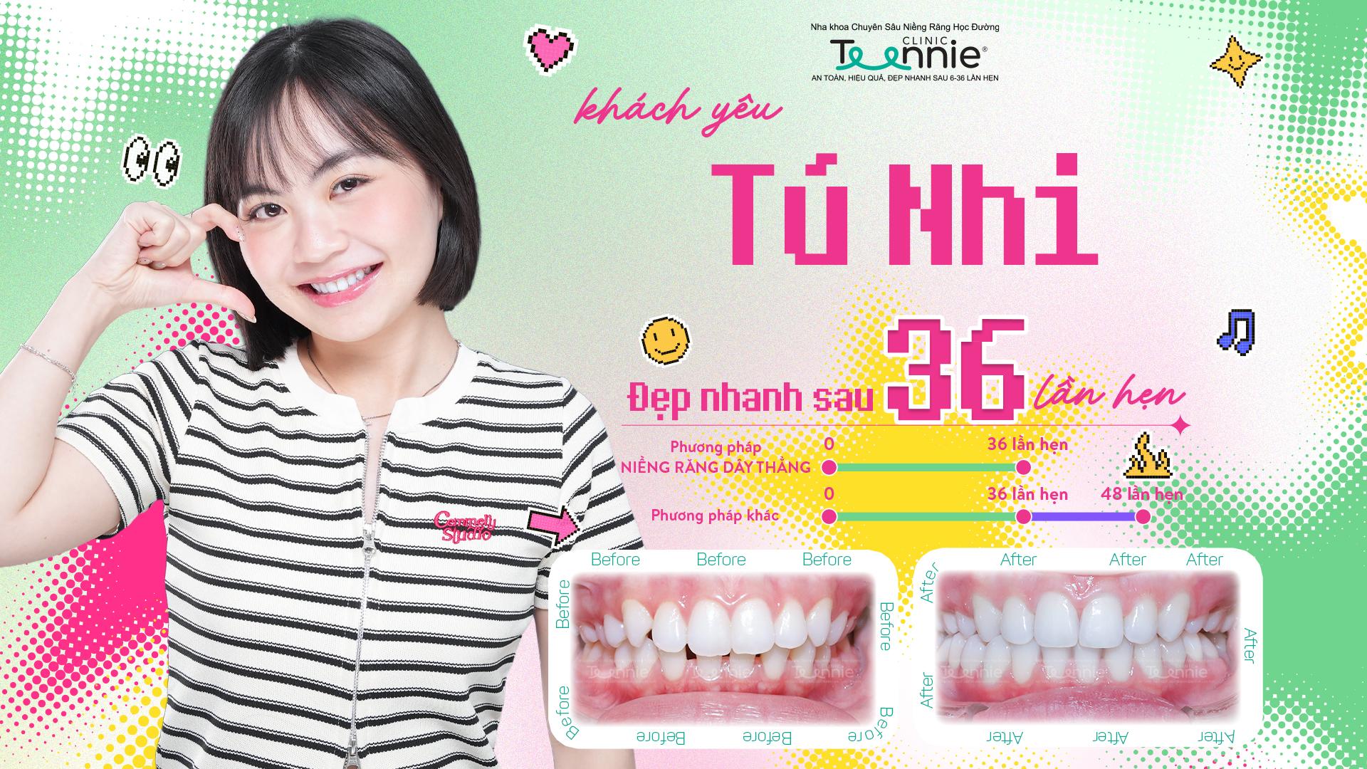 niềng răng văn phòng tphcm - hình 3