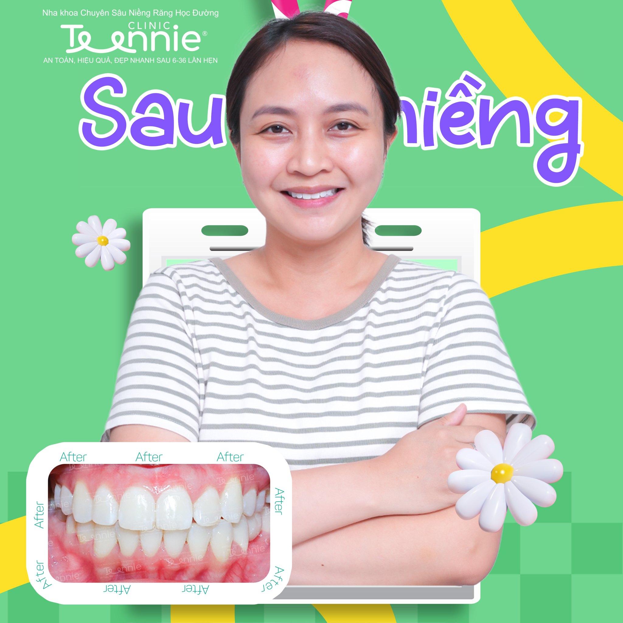 niềng răng văn phòng tphcm - hình 4