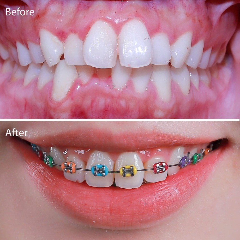 niềng tự buộc kinh điển - hình 2